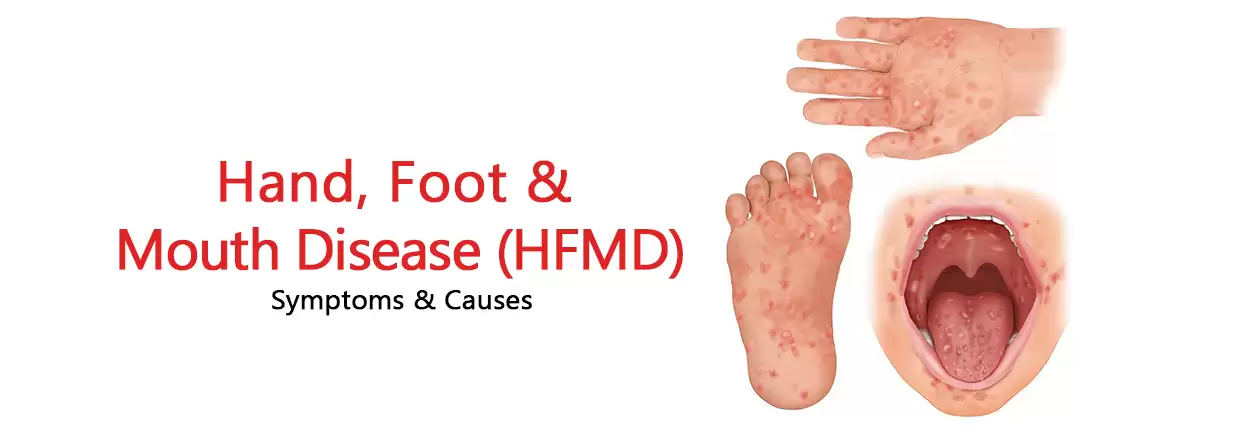 Understanding Hand, Foot & Mouth Disease (HFMD): Symptoms & Causes